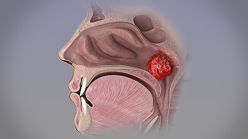 Adenoid and Adenoidectomy | Sanjay Hospital