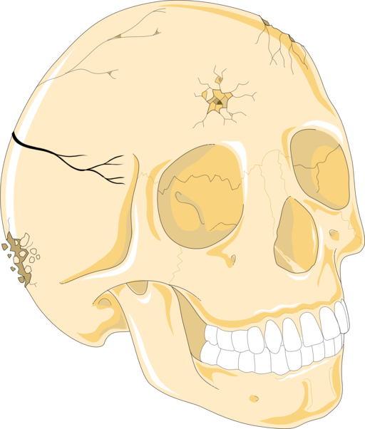 depressed-skull-fracture-symptoms-treatment-sanjay-hospital