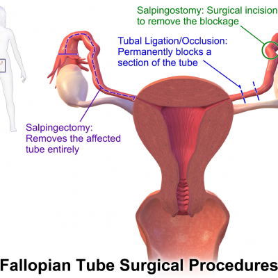Laparoscopic Tubectomy
