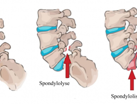 Lumbar Spondylitis