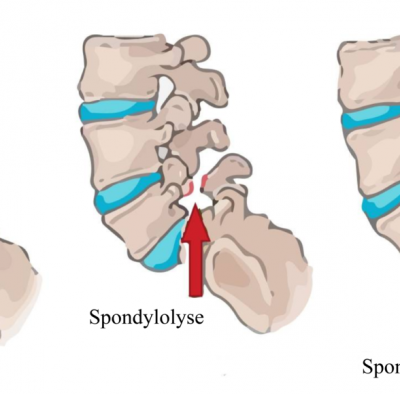 Lumbar Spondylitis