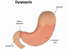 Non-Ulcer Dyspepsia