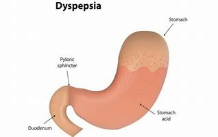 Non-Ulcer Dyspepsia