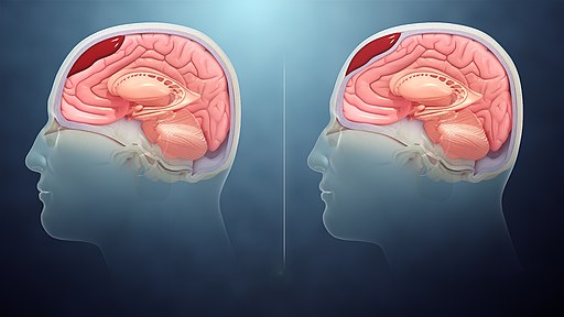 Subdural Hematoma | Symptoms And Treatments | Sanjay Hospital